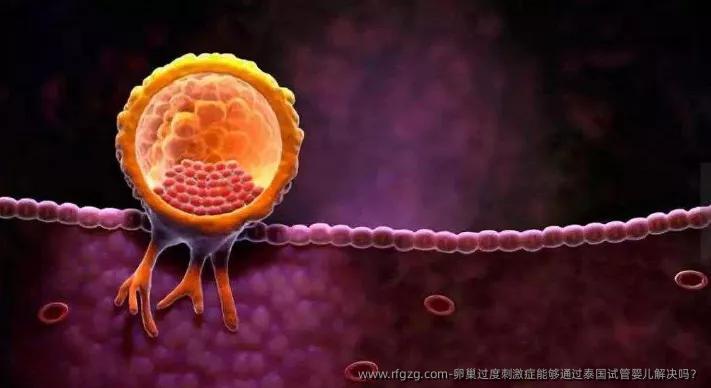 卵巢过度刺激症能够通过泰国代孕解决吗？