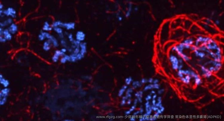 少弱畸形精子症患者遗传学筛查 常染色体显性多囊肾(ADPKD)